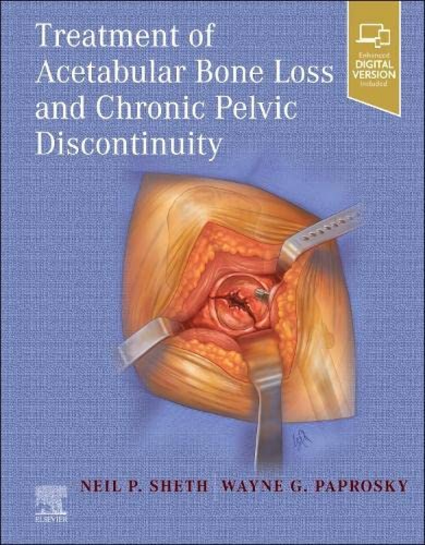 Portada de Treatment of acetabular bone loss and chronic pelvic