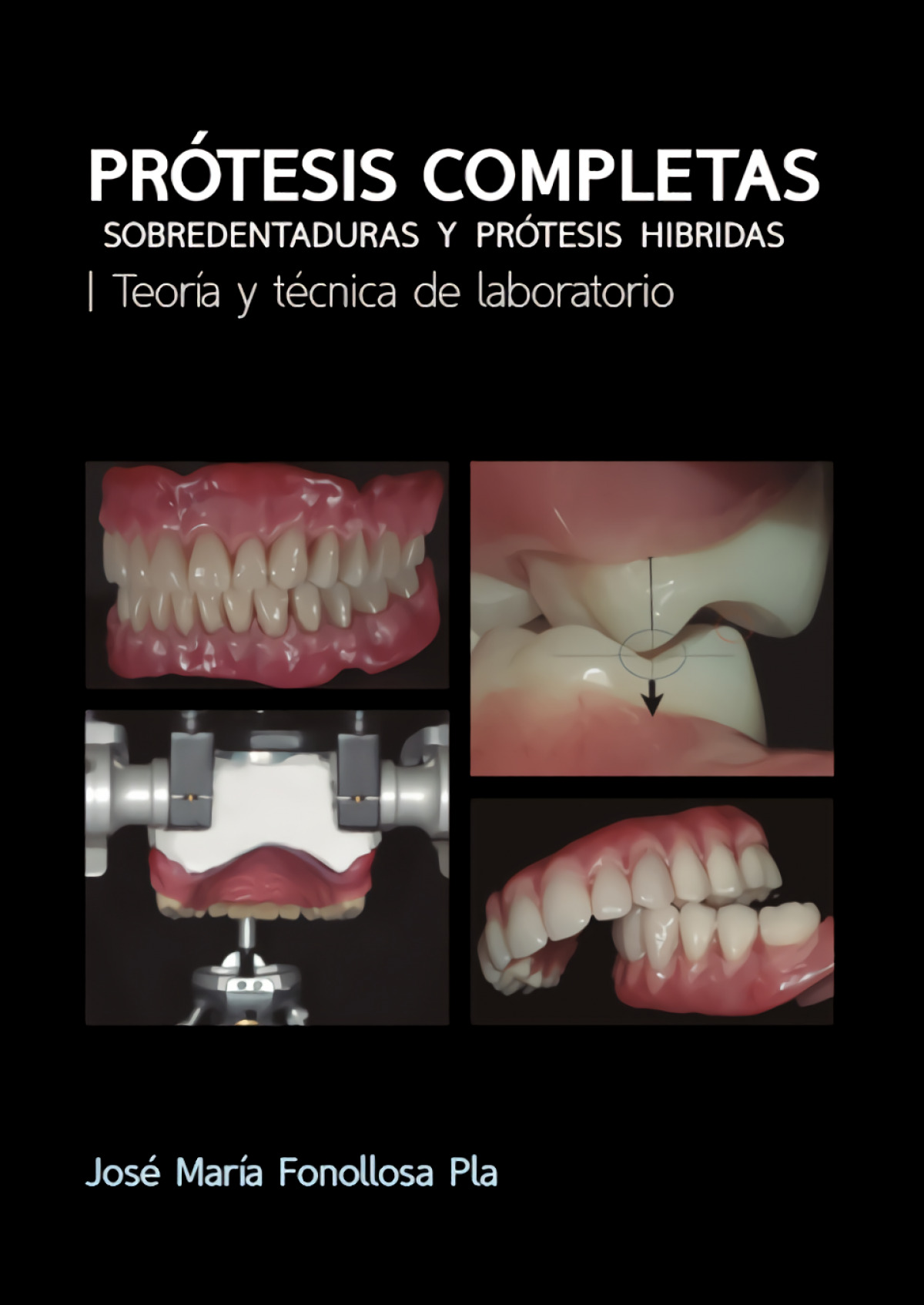 PRóTESIS COMPLETAS. SOBREDENTADURAS Y PRóTESIS H¡BRIDAS. TEOR¡A Y T'CN