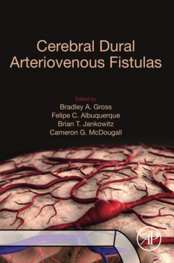 CEREBRAL DURAL ARTERIOVENOUS FISTULAS