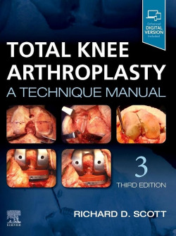 TOTAL KNEE ARTHROPLASTY