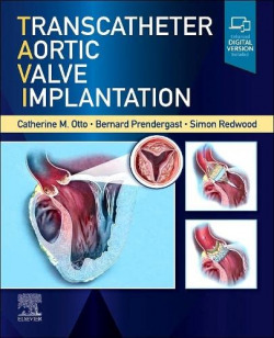 Transcatheter aortic valve implantation