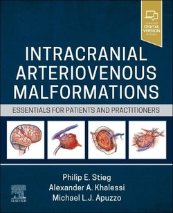 INTACRANIAL ARTERIOVENOUS MALFORMATIONS