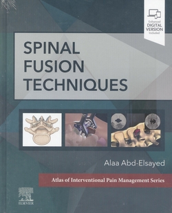 Spinal fusion techniques