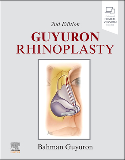 Rhinoplasty