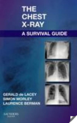 The Chest X-Ray: A Survival Guide