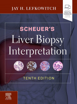 Scheuer´s liver biopsy interpretation