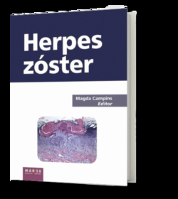 Herspes Zoster