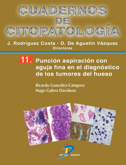PUNCIóN ASPIRACIóN CON AGUJA FINA EN EL DIAGNOSTICO TUMORES HUESO