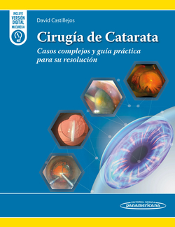 Cirugía de Catarata